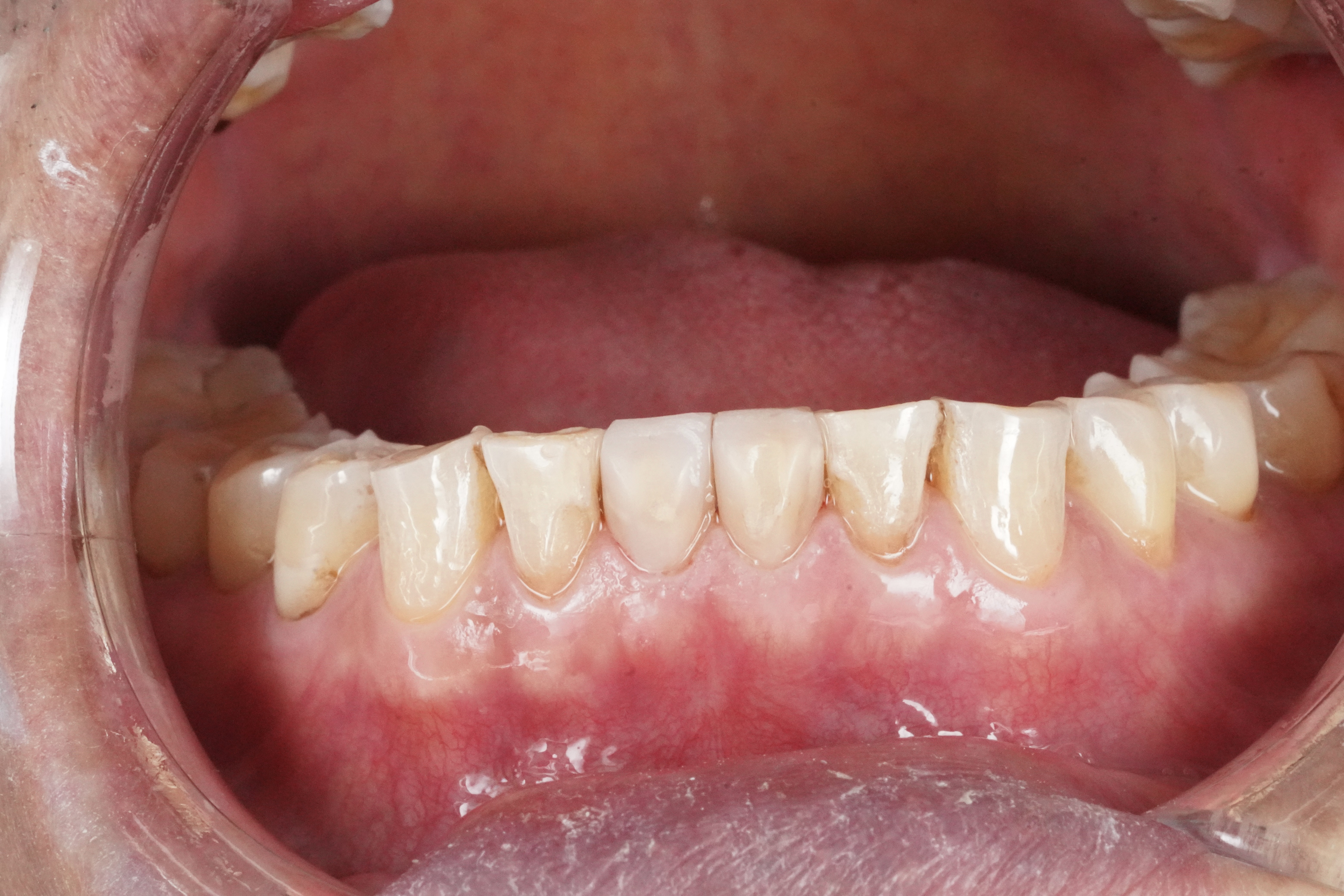 After treatment